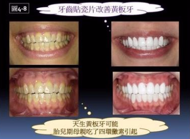 黃牙,美白,牙齒顏色,牙齒漂白,冷光美白,假牙,瓷牙,瓷牙貼片,貼片