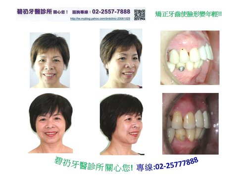 牙齒排列可以改變臉型,矯正,隱適美,透明牙套,矯正費用收費