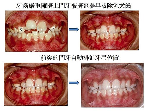 牙齒嚴重擁擠,碧礽牙醫診所建議預防性矯正,系列性拔牙,碧礽牙醫診所專線02-25777888