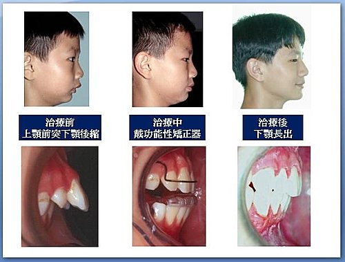 功能性矯正器,兒童矯正,門牙前突,換牙期,咬合異常
