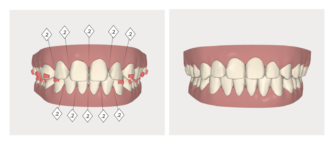 口内,口外相片,全口x光片,侧头颅x光片 正常的牙齿咬合是上排牙齿会